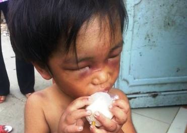 Cháu bé 3 tuổi bị đánh bầm dập, chích thuốc lá bắt đi ăn xin